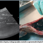 Ultrasonic aspects of the adrenal glands in DiHor